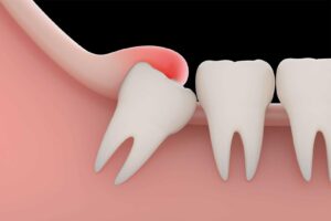 A visual representation of an impacted wisdom tooth causing swelling.